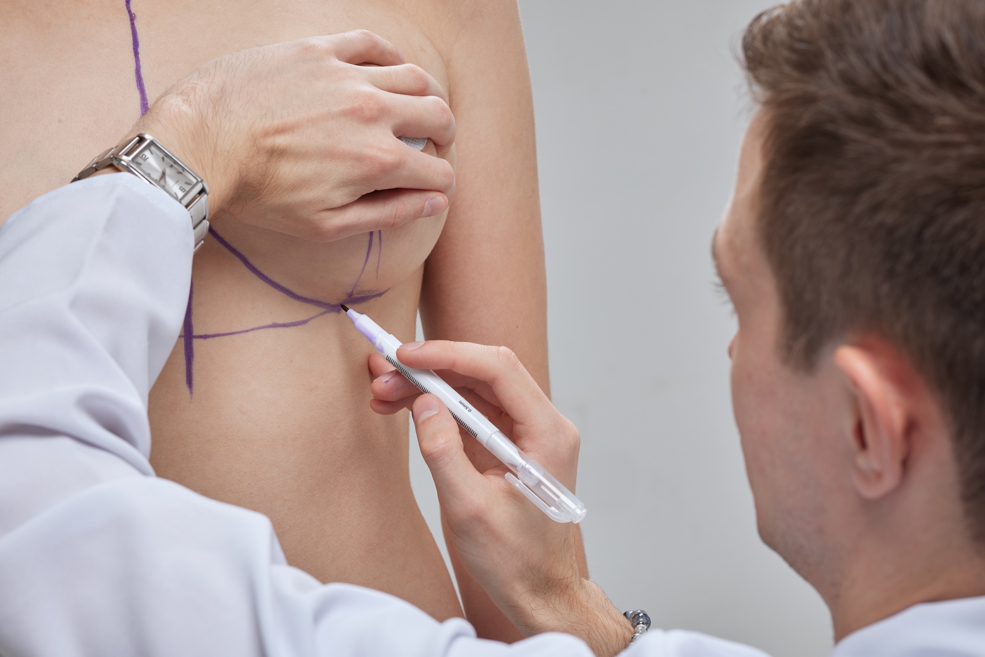 Doctor hand drawing lines on woman breast, breast implant surgery concept.
